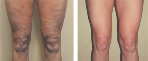 skin-tightening-thighs - Estetika Skin & Laser Specialist