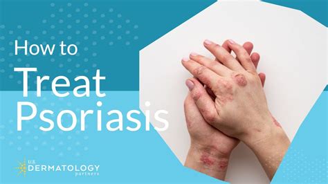 Psoriasis Treatment - Explained by Dermatologist - YouTube