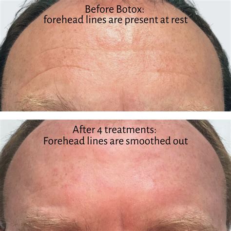 Can Botox treat deep forehead wrinkles? Yes! Here’s how. | Ageless Aesthetics & Natural Medicine ...