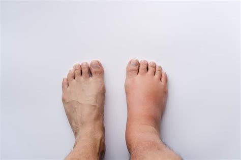 Everything you need to know about Cankles | The Vein Institute