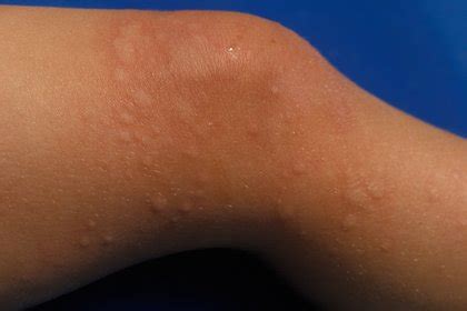 Itchy White Bumps On Skin