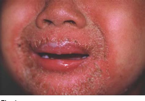 Figure 3 from Perianal Streptococcal Dermatitis | Semantic Scholar