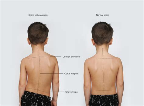 What if my child has scoliosis? - Palermo Physiotherapy & Wellness ...