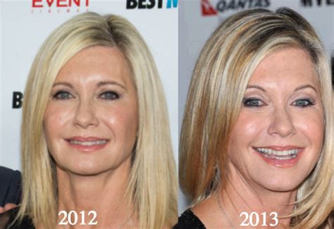 Olivia Newton-John Plastic Surgery Before and After Photos - Latest Plastic Surgery Gossip And ...