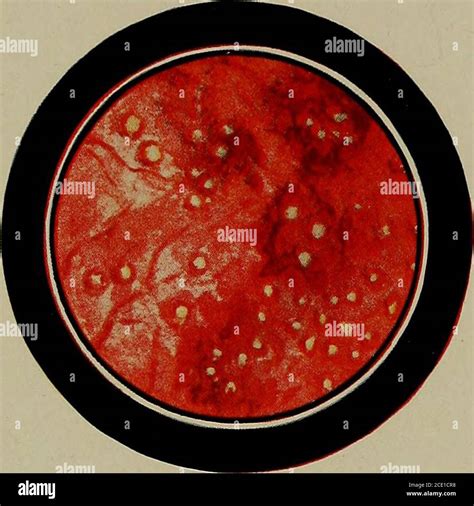 Gumma syphilis hi-res stock photography and images - Alamy