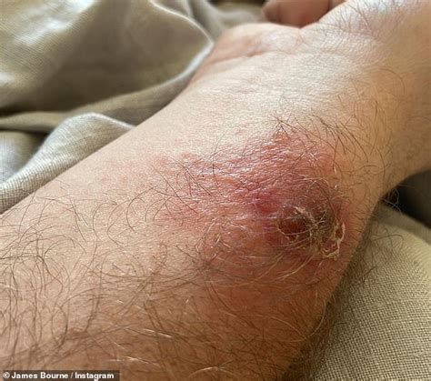 Busted star James Bourne rushed to hospital after being bitten by a spider