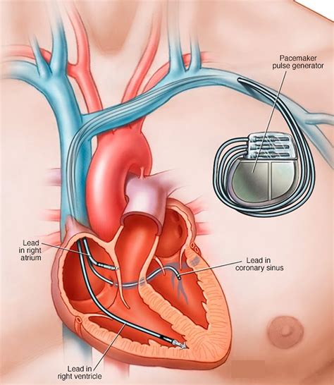 What To Do When Pacemaker Battery Dies - Free Word Template