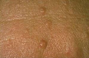 👉 Sebaceous Hyperplasia - Pictures, Removal, Symptoms, Treatment ...