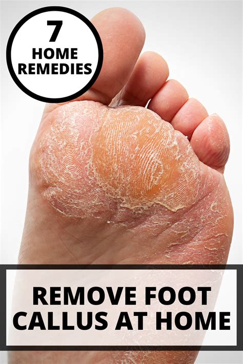 How To Remove Foot Callus At Home in 2021 | Foot callus, Foot remedies ...