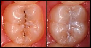 What Are Fissure Sealants? - Dentist in Bounds Green - Dental Blog - Brightside Dental