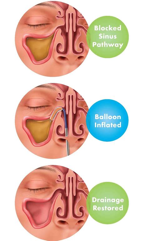 Balloon Sinus Dilation | Nasal Balloon | St. Louis Sinus Center