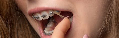 How Often Should You Change Your Braces Elastics? - The Braces Guide