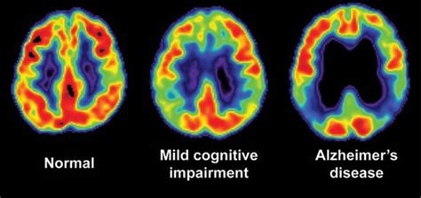 Brain Imaging for Alzheimer's & Dementia | Pacific Brain Health Center