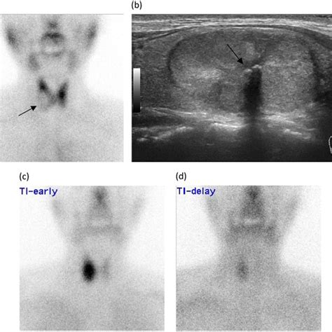 a A Tc-99m scintigraphy image showing a cold thyroid nodule (arrow) in... | Download Scientific ...