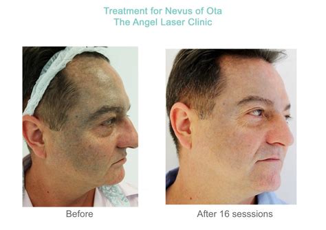 Nevus of Ota treatment in London – The Angel Laser Clinic