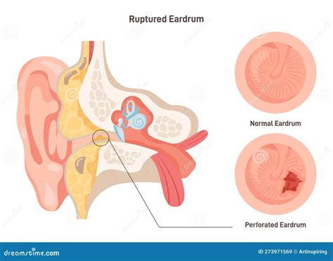 Timpano Rotto. Anatomia Dell'orecchio Umano. Sano E Perforato Illustrazione Vettoriale ...