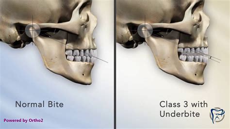 Class III Bite Cause - YouTube