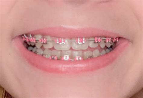 Pink Braces - What's The Right Color For You? - Fun Footer