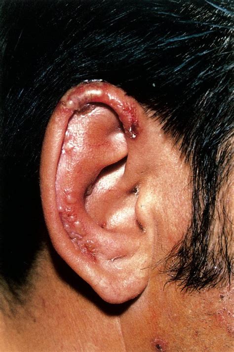 Bacterial Otitis Externa