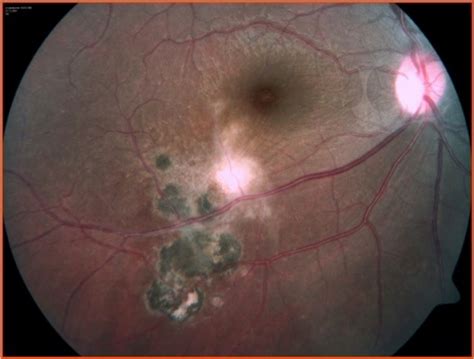 Ocular Toxoplasmosis | Consultant360