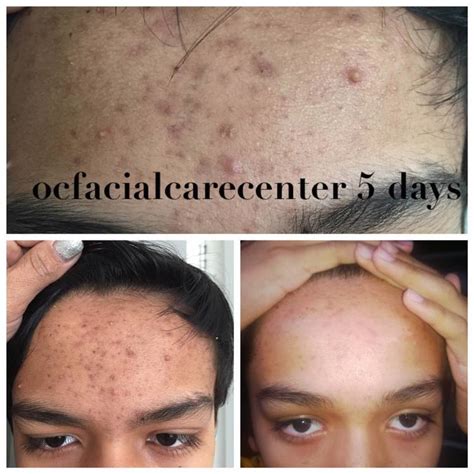 Before And After Photos |OC Facial care centre : Facial Treatments | Chemical Peeling | Waxing