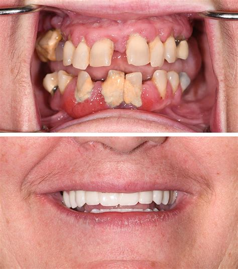 Patient 317478 | Full Mouth Reconstruction Before & After Photos | Grand River Dental