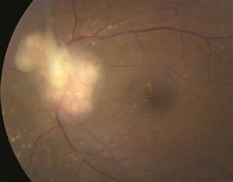 Optic Nerve Disorders Diagnosis | AccessMedicine Network