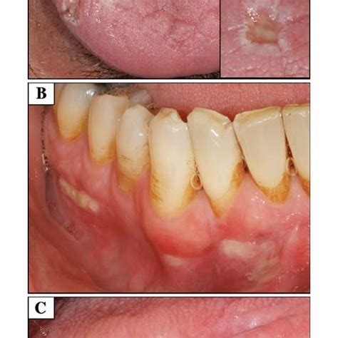 Initial presentation: The dorsal tongue exhibits fissures and multiple ...