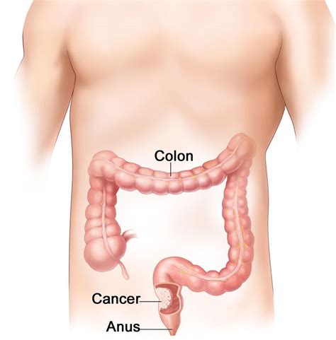 Can a Groove on One Side of Your Poops Mean Colon Cancer? » Scary Symptoms