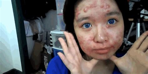 With Really Bad Acne Makeup Tutorial - Mugeek Vidalondon