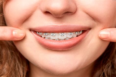 Ortodoncia Brackets - COS Clínica Dental