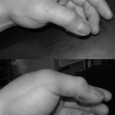 Anteroposterior and lateral X-rays of the left thumb showing volar... | Download Scientific Diagram