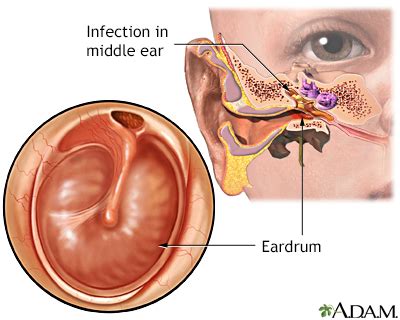 Chronic Ear Infection - Symptoms and Causes