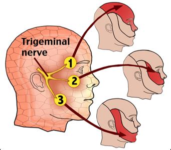 Trigeminal Neuralgia - Ayurvedic Treatment & Home Remedies