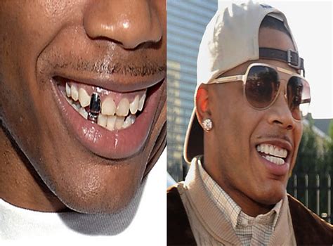 Celebrity Teeth Before And After