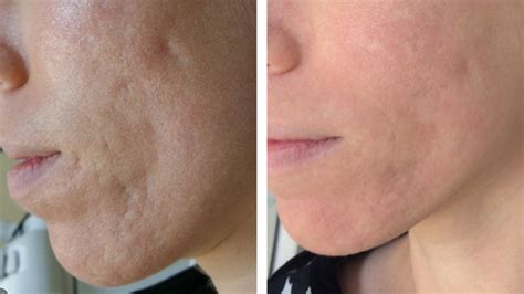 Laser Acne Scar Removal: Does It Work? Metro Dermatology | vlr.eng.br