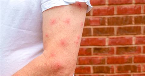 Mosquito Bites Pictures Allergic Reaction
