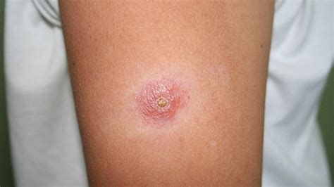 Leishmaniasis: Causes, Symptoms, Diagnosis and Treatment – Page 5 ...