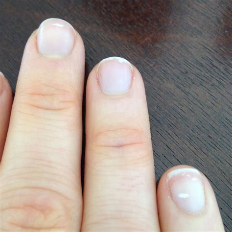 0 Result Images of White Spots On Fingernails - PNG Image Collection