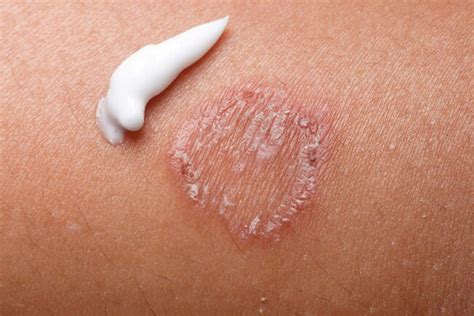 10 Most Common Types of Skin Rashes | Daily Health Valley