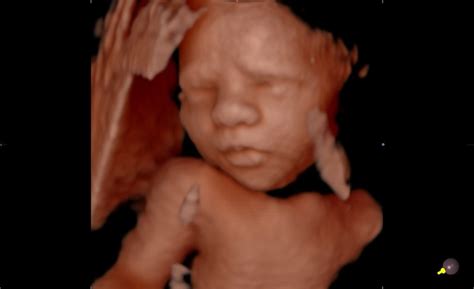 Pregnancy Ultrasounds 2D, 3D, 4D and 5D-HD