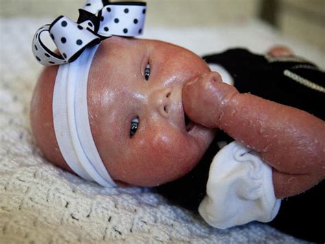 Meet Brenna, a baby with Harlequin Ichthyosis - Photo 2 - Pictures ...