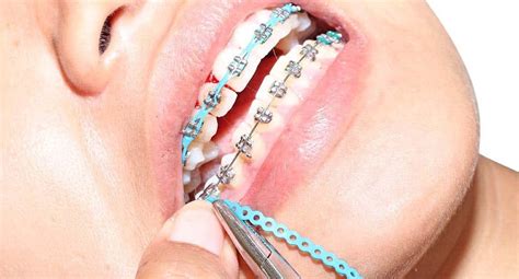 Braces Removal Process: Here’s What You Need to Know - Istoso Visto - Healthy and happy living