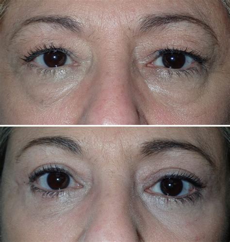 Today's Great Little Case: Upper & Lower Eyelid Laser Blepharoplasty With Lower Lid Laser ...