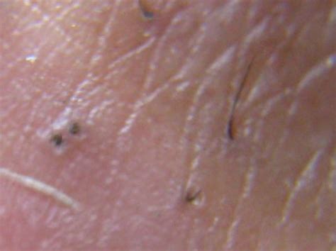 What is Morgellons Disease? | Perfect Health Alert, Ehlers Danlos Syndrome, Lyme, The Good Old ...