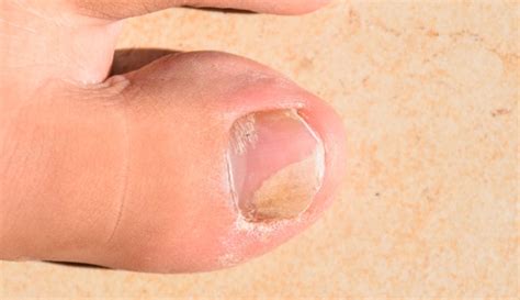 How to Tell if You Have a Toenail Fungus - Colorado Center of Orthopaedic Excellence