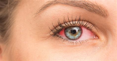 Dry Eye Testing & Treatment - Eyes & Optics of Pearland