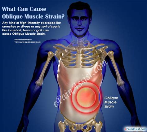 Oblique Muscle Strain|Causes|Symptoms|Treatment|Recovery