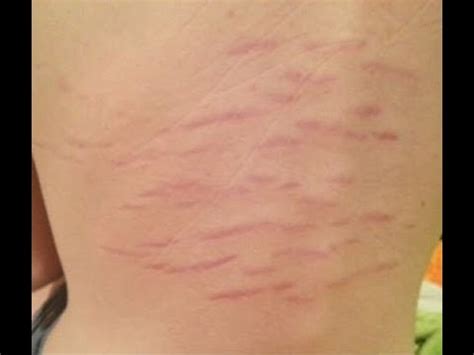 Morgellons Disease Symptoms