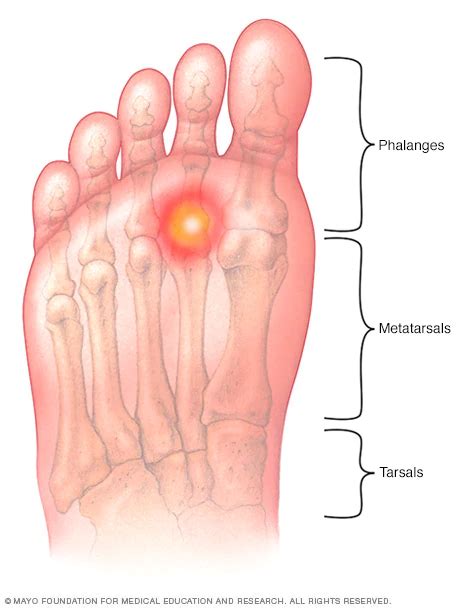 Metatarsalgia symptoms and causes – Artofit